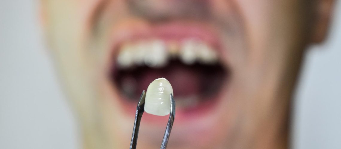 Zirconia Crowns in Dubai Explained The Ultimate Guide