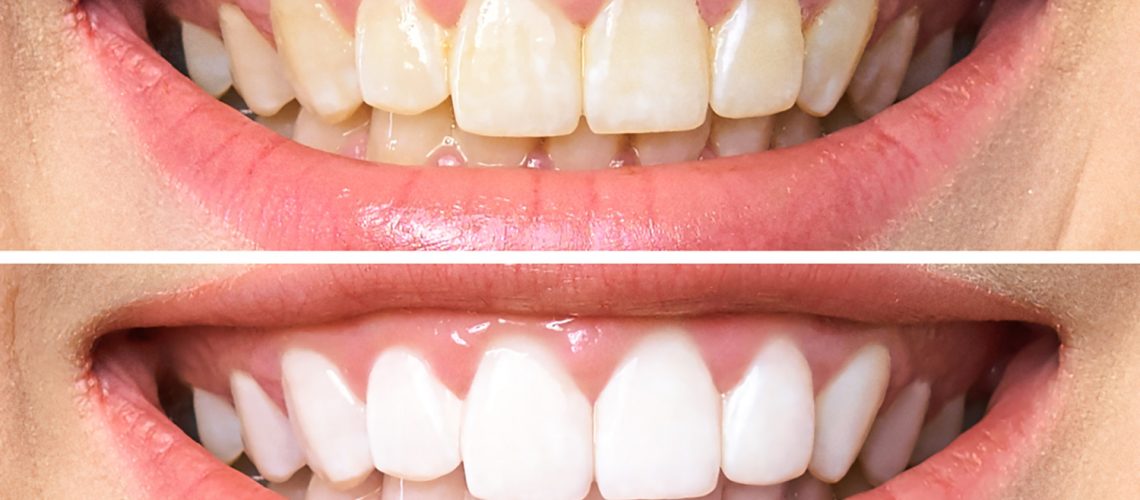 How to Clean Stained Teeth Proven Methods for Whiter Teeth