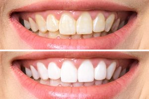 How to Clean Stained Teeth Proven Methods for Whiter Teeth